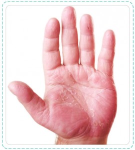 hand_allergy